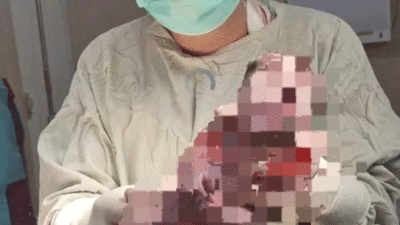 Seorang bayi disebut terlahir bermata satu. (gambar sengaja diblur demi kaidah pers)