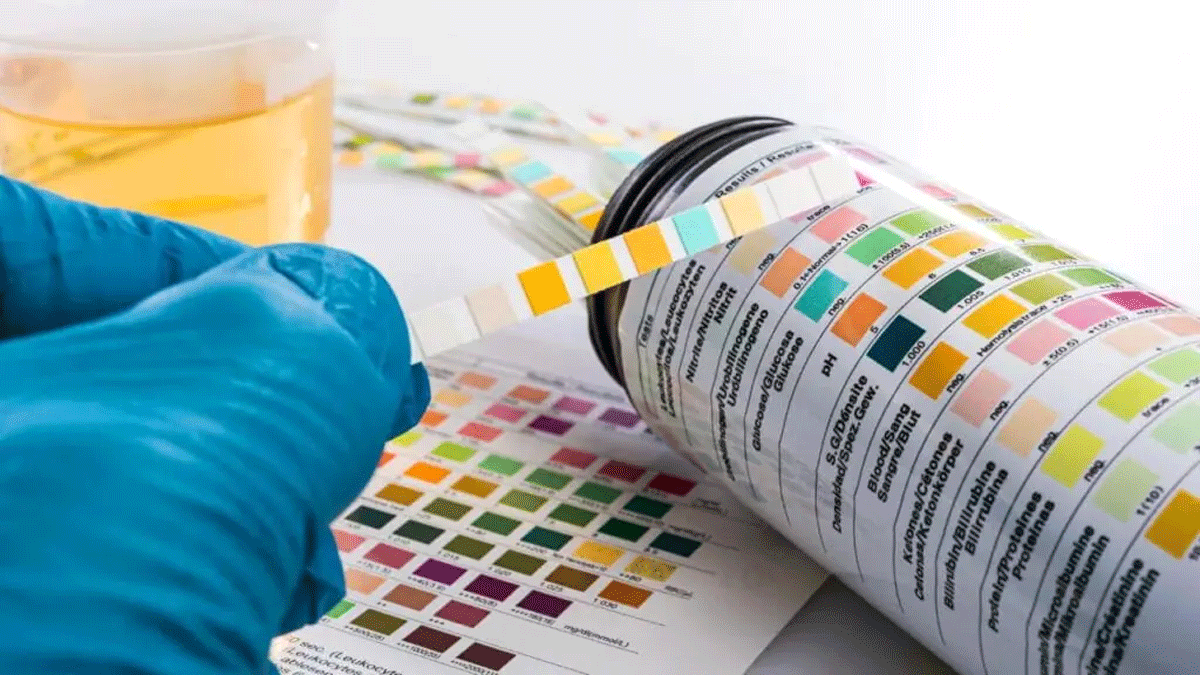 Ilustrasi tes urine.